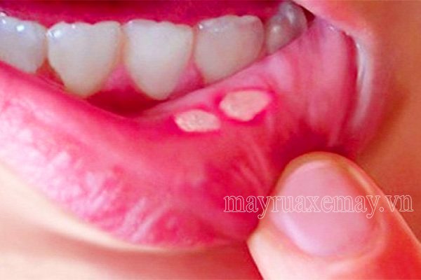 Nhiệt miệng là gì? Nguyên nhân và cách điều trị nhiệt miệng tại nhà